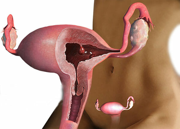 Полип эндометрия в матке: причины и лечение без операции, симптомы и отзывы