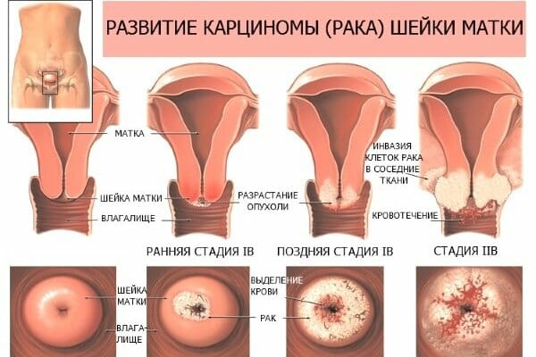 Рак матки симптомы у женщин на ранних 23