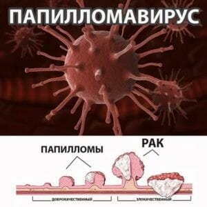 Папилломавирус и рак
