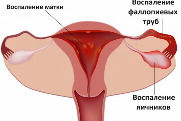 Воспаление матки, труб и яичников