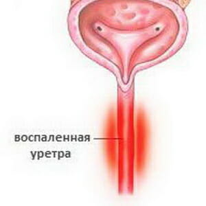Воспаление уретры