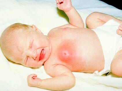 Набухание грудных желез у новорожденного