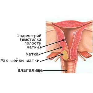 Рак матки