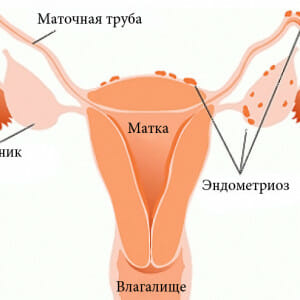 Эндометриоз матки