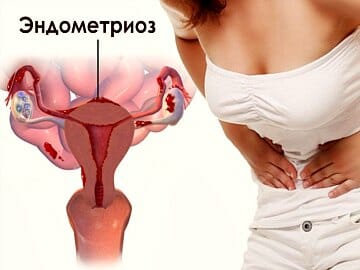 Изображение эндометриоза и женщины