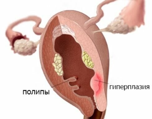 Полипы и гиперплазия в матке