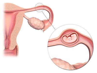 Эмбрион вне матки