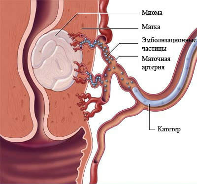 Эмболизация маточных артерий