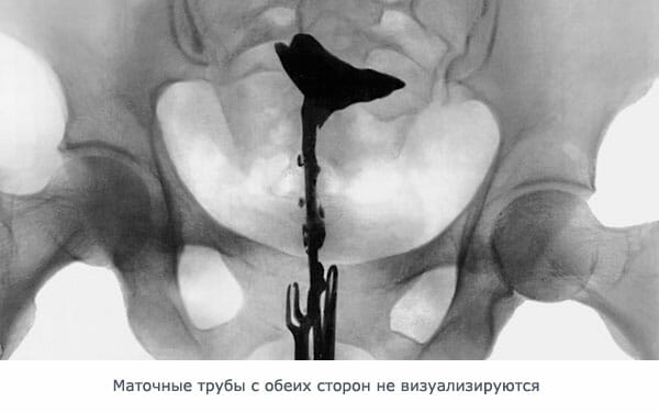 Рентген полной непроходимости маточных труб