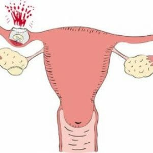 Эмбрион порвал маточную трубу