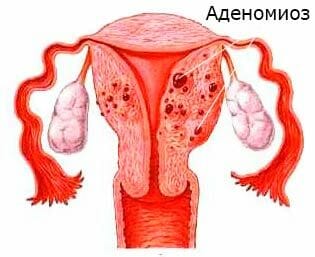 Изображение аденомиоза матки